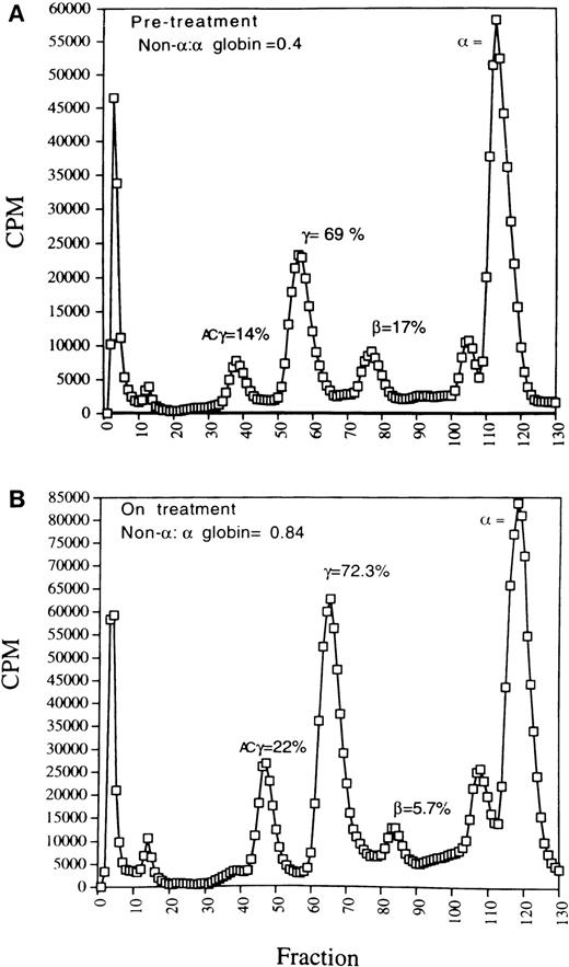 Fig. 2. Globin chain synthesis in a representative patient with β+ thalassemia (patient no. 5) who received butyrate therapy. (A) Baseline profile (pretreatment); (B) with butyrate (moderate dose, 1,200 mg/kg/d) therapy. The elution positions of the , β, γ, and acetylated γ (ACγ) are indicated. Non-: globin chain balance improved by approximately twofold with butyrate therapy due to an increase in acetylated γ-globin and γ-globin synthesis and despite a relative decrease in β-globin synthesis.