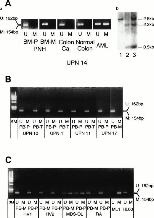 Fig. 1. Methylation status of the p15INK4Bgene in patients with PNH. (A) Methylation status of thep15INK4B gene in a patient (UPN 14) with acute myelogenous leukemia (AML) evolved from PNH. (a) Unmethylated DNA-specific and methylated DNA-specific MSP primers produced 162-bp and 154-bp products, respectively. Bone marrow (BM) samples at PNH (BM-P, polymorphonuclear cells; BM-M, mononuclear cells), his colon cancer, and normal colon tissue resected 1 year after PNH presentation showed unmethylated p15INK4B gene. In contrast, leukemic blasts showed hypermethylation of thep15INK4B gene. (b) Southern blotting also showed the methylated status in leukemic blasts4; lanes 1 and 2, control B lymphocytes. Lane 3, patient’s leukemic blasts. (B) Methylation status of the p15INK4B gene in patients with PNH. All samples obtained from peripheral blood (PB) showed unmethylated pattern. PB-P, polymorphonuclear cells; PB-M, mononuclear cells; PB-T, T lymphocytes; SM, size marker (ØX174/HaeIII). UPNs are common to those in our previous report.5 (C) Methylation status of the p15INK4B gene in control samples. Two healthy volunteers (HV) showed unmethylated pattern. A patient with overt leukemia evolved from MDS (MDS-OL) showed intense methylation in both PB-M and PB-P populations, whereas a patient with refractory anemia (RA) showed faint methylation. ML1 and HL60 were completely methylated and unmethylated, respectively, as previously reported.4