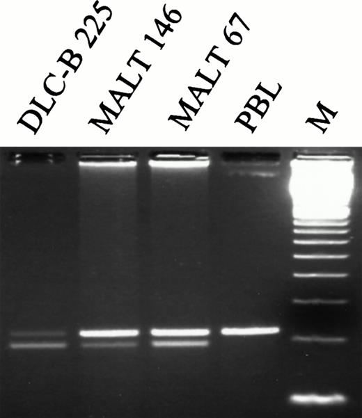 Fig. 3. RT-PCR analysis of Fas mRNA in NHLs. A region encompassing exons 7-9 was amplified with primers FAS533 and FAS737 in three lymphoma samples in which mutations had been identified in the acceptor splice site of Fas intron 7 (IVS7nt-2a → g; DLC-B 225), or in the donor splice site of Fas intron 8 (IVS8nt + 5g → a, MALT 146; and IVS8nt + 5g → c, MALT 67). In all three samples, skipping of exon 8 was demonstrated by the occurrence of a shorter band that was not present in RNA isolated from peripheral blood lymphocytes of a normal volunteer (PBL). M, 100-bp ladder.