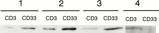 Fig. 3. Detection of caspase 3 protein in CD3+ and CD33+ cells obtained from AML peripheral blood low-density cells. Data from four of eight patients are depicted.