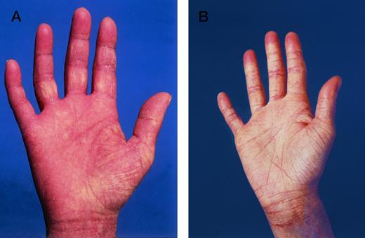 Fig. 2. Lichenoid GVHD involvement of the palms in patient no. 6 (Fig 1A) (A) before and (B) in complete remission after ECP.