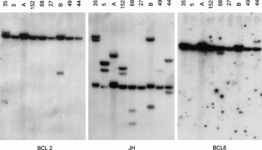 Fig. 1. Southern blot analysis of IgH, BCL2, and BCL6 gene rearrangement. Tumor DNA samples from cases 35, 5, 152, 68, 27, 49, 44 (see Table 1) and 2 other lymphomas (lanes A and B) not included in the study were digested with BgIII and hybridized with probes for BCL2 (pSP64/18-4RH for MBR), JH (pCm51/JH), and BCL6 (pGSc4.0 for the 3′ region of exon 1a of BCL6). All tumors except case 27 showed 1 or more rearranged JH bands, indicating sufficient tumor DNA. Case 27 showed 2 strong rearranged JH bands in both theHindIII and EcoRI digests (not shown), indicating that the BgIII digest was false-negative. Case 35 showed rearrangement for BCL2, and cases 68 and 44 showed rearrangements for BCL6. Comigration of 1 rearranged BCL2 and 1 rearranged JH band in case 35 indicates t(14;18). Case 152 did not show BCL6 rearrangement but had BCL6 rearrangement upon analysis with the pGSc4.0 probe in theHindIII digest, as well as F370 and F372 BCL6 probes in theBgIII digest and the F370 probe in the EcoRI digest. This indicates that the BCL6 breakpoint is present in the MTC of BCL6 (not shown).