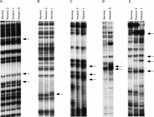 Fig. 1. ddF analysis of the factor XI gene. Autoradiographs of ddF analysis are shown for exons that gave discordant results between the patients and the control individuals designated as normal. (A) exon 5, (B) exon 7, (C) exon 8-9, (D) exon 9-10, and (E) exon 11. The arrows identify the positions of new or shifted bands in the patient samples that indicate the presence of nucleotide changes.