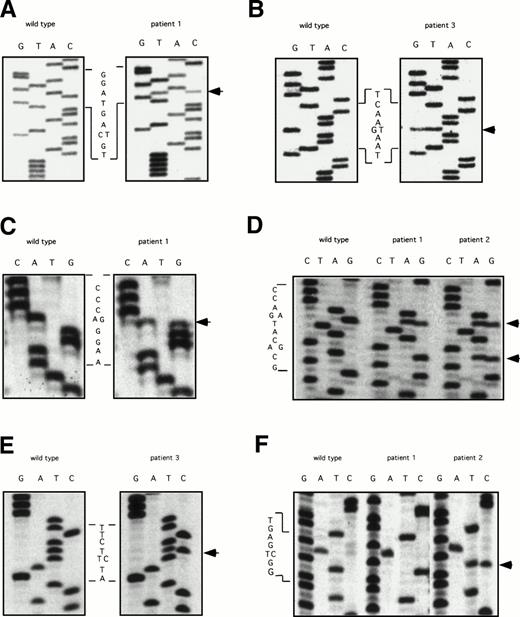 Fig. 2. DNA sequencing of PCR products with abnormal ddF patterns. The arrows indicate the locations of nucleotides that differ from the published sequence for wild-type human factor XI.28 (A) exon 5: C to T at nucleotide 472, no amino acid change; (B) exon 5: G to T at nucleotide 446, changing glutamic acid 117 to a stop codon; (C) exon 7: A to G at nucleotide 774, changing glutamine 226 to arginine; (D) exon 8: G to A (top arrow) at nucleotide 840, changing serine 248 to glutamine and A to G (bottom arrow) at nucleotide 844, no amino acid change; (E) exon 9: T to C at nucelotide 944, changing phenylalanine 283 to leucine; and (F) exon 11: T to C at nucleotide 1234, no amino acid change.