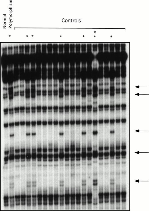 Fig. 3. ddF analysis of exon 11 in a group of normal volunteers. ddF was performed as described in Materials and Methods. The asterisk indicates samples in which the presence of the neutral T to C change at nucleotide 1234 was identified by the appearance of new or shifted bands on the autoradiograph (indicated by the arrows). The sample indicated by the double asterisk comes from a person who is homozygous for the polymorphism, whereas the samples indicated by the single asterisk are from heterozygotes.