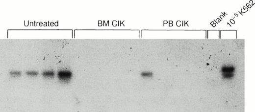 Fig. 4. In vivo activity of autologous CIK cells. Southern hybridization of bcr-abl RT-PCR products from the spleens of 12 mice injected with CML cells in matrigel followed by autologous CIK cells. Lanes 1 through 4, control mice not receiving CIK cells; lanes 5 through 8, mice treated with autologous BM-derived CIK cells; lanes 9 through 12, mice treated with autologous CIK cells derived from the peripheral blood; lane 13, buffer control; lane 14, 1 in 105 dilution of chronic-phase CML cells in murine cells.