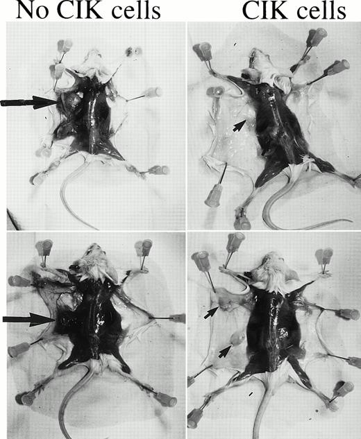 Fig. 5. EBV-associated lymphoma in control versus CIK cell–treated mice. SCID mice were injected with low-density CML cells from patient M.R. in matrigel. Groups of mice were treated with autologous CIK cells at 4 and 8 weeks following the injection of the CML cells. At 12 weeks the majority of the mice developed lymphomas that were found to be EBV associated. Two control mice that did not receive CIK cells are shown in the left hand panels. The large arrows indicate the lymphomas. On the right hand panel two mice who received CIK cells at week 4 are shown. No tumors are visible, but the remains of the matrigel can be seen (small arrows).