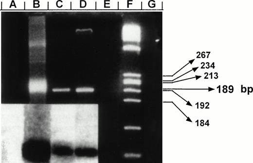 Fig. 1. Negative-polarity strand HCV RNA and specificity of CAP-based RT-PCR assay. Products were fractionated on a 3% agarose gel and stained with ethidium bromide. Lane B: detection of synthetic HCV negative strand RNA generated from the vector pRTI HCV cDNA containing HCV capsid sequences cloned into pBluescript (Stratagene, San Diego, CA).24 Lanes A, E, and G: negative control reactions in which RNA templates were amplified in the absence of RT, omitting specific primers, or in nucleic acids extracted from CD34+ cells of a HCV-negative control, respectively. Lanes C and D: RT-PCR products for negative strand HCV RNA amplified from highly purified samples of CD34+ cells from patients no. 5 and 6, respectively. Results were confirmed after Southern blotting (inserted panel). A total of 1 μg of RNA extracts prepared from CD34+ cells was used along with 250 ng outer sense primer (5′CCAAAACCCCAAAGAAA3′, position: 750) for cDNA synthesis. Resulting cDNA was amplified after addition of 250 ng of the outer antisense primer (5′GTACCCCATGAGGTCGGCG3′, position: 355). A second PCR reaction was performed using a set of internal primers (sense-5′CAGATCGTTGGTGGAGTT3′, position: 427; antisense-5′CAAGCCCTCATTGCCAT3′, position: 616). The resulting product of 189 bp was probed after Southern blotting using a P32-labeled oligomer (5′GGTCGCAACCTCGAGGTAGACGTCAGCCT3′, position: 506). Lane F: molecular markers (HaeIII-digested ◊X174). Predicted size of amplified fragment is indicated in base pair (bp).