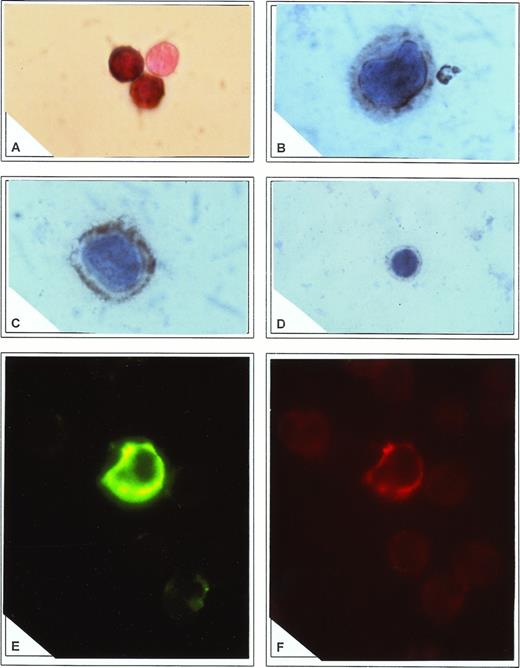 Fig. 3. (A) Direct in situ RT-PCR to amplify 5′-NC region of HCV genome in CD34+ cells. Note the complete absence of reaction in an adjoining cell. Immunocytochemistry to detect core (B) and E2/NS1 (C) antigens in CD34+ cells. In both cases a cytoplasmic appearance of immune reactants was found. Note adhesion of the core antigen to the nuclear membrane and accumulation of E2/NS1 antigen in cytoplasmic submembrane spaces. In (D) core reactivity was blocked by preadsorption of antibody with recombinant HCV core antigen. (E) Staining of CD34+ cells with FITC-conjugated anti-E2/NS1 protein. Specific signal outlining nonfluorescent nuclei is demonstrated. (F) The same cell as described in (E) was shown to coexpress CD34 antigen, stained with PE-labeled antibody.