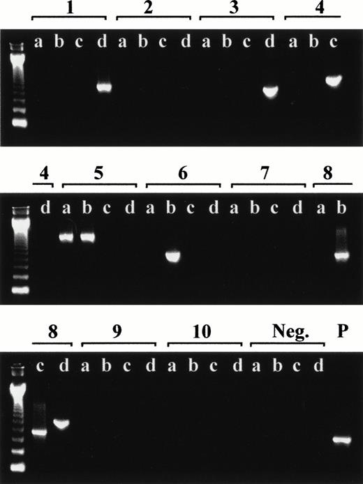 Fig. 2. Representative RT-PCR screening for p190 BCR-ABL transcripts in leukocytes from a healthy adult. The ethidium-bromide–stained agarose gels show quadruplicate PCRs (labeled a, b, c, and d) for each cDNA aliquot (labeled 1 through 10) including 1 of the 4 negative (Neg.) controls and 1 positive (P) control specimen (SD1 cell line). The first lane on each gel is a 123-bp DNA ladder marker.