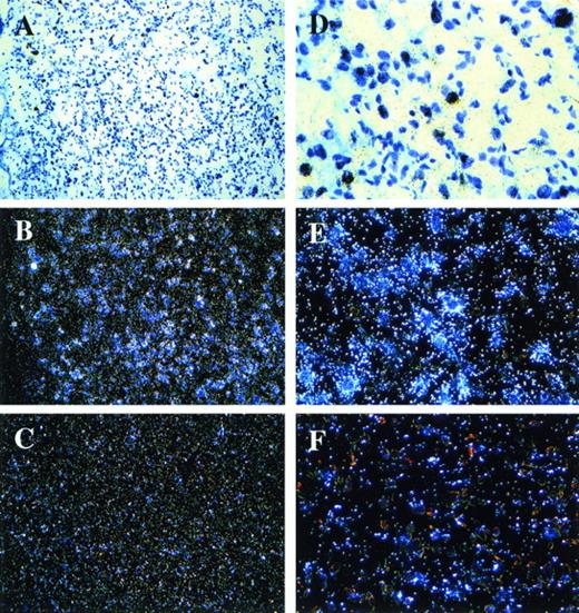 Fig. 2. In situ hybridization for Epo mRNA in a human hemangioblastoma using 35S-labeled antisense and sense cRNA probes. Sections were counterstained with toluidine blue. Epo mRNA was detected in intervascular stromal cells. A-C, 100× original magnification; D-F, 400× original magnification; A and D, bright field illumination; B and E, dark field illumination; C and F, sense (control) hybridization and dark field illumination.