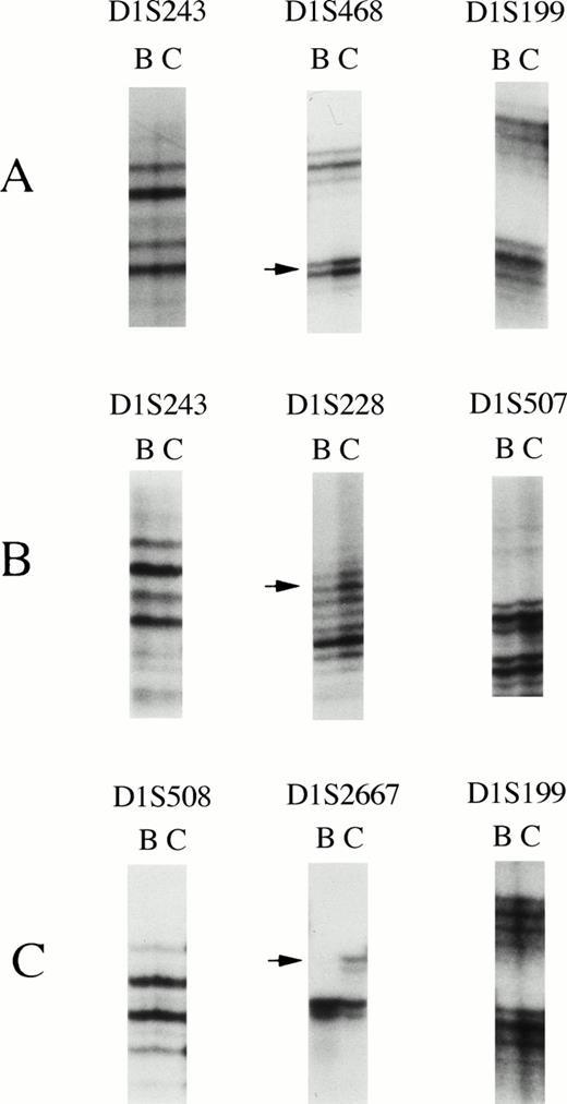 Fig. 1. Loss of heterozygosity on chromosome arm 1p in CML. (A) LOH was detected on D1S468 in CML no. 11. Heterozygosity was retained at D1S243 and D1S199. (B) Allelic loss was observed at D1S228, whereas heterozygosity was retained atD1S243 and D1S507 (CML no. 24). (C) LOH was found atD1S2667, whereas heterozygosity was retained at D1S508and D1S199 (CML no. 1). The locus symbol is shown on the top. Arrow indicates allele lost. B, blast crisis; C, chronic phase.