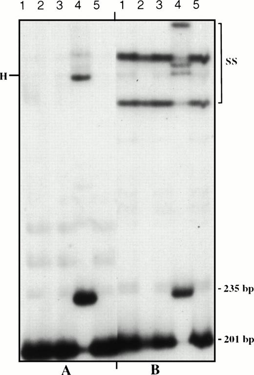 Fig. 3. Analysis of exon 6 of the PIG-A gene before BMT and after relapse. (A) Heteroduplex Analysis (HA); Two extra bands (235 bp, mutant homoduplex; H, heteroduplex) in patient MSK13 are clearly observed after relapse (lane 4) but not before BMT (lane 2). (B) Single-Strand Conformation Analysis (SSCA). Along with double-stranded fragments DNA, an altered electrophoretic mobility (shift) of the single-stranded DNA (SS) is only present after relapse (lane 4). Normal controls (lanes 1, 3, 5); normal homoduplex, 201 bp.