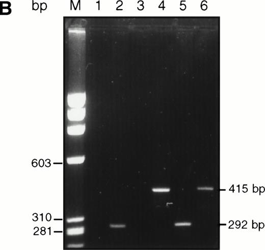 Fig. 5. High-sensitivity analysis of the 1355insAA-duplication nt 1324-1355 before and after BMT. (A) Schematic representation of the insertion-duplication in exon 6 of the PIG-A gene. At the top, two copies of the normal sequence are aligned to show direct-sequence homology (underlined) that may favor nonhomologous exchange below the sequence in the recent sample of patient MSK13. Identical bases are indicated by a vertical line. The short repeat of 4 nt flanking the duplication are boldface. The 19 mer D has been designed to match completely the mutant sequence, whereas the last 4 nt (5′-… .ttTC-3′) are mismatched to the normal sequence (see arrow bent at the left). The fragment amplified with primers -I5b and D and -I5b and f are expected to be 292 bp and 415 bp in length, respectively. (B) Gel electrophoretic analysis of nested-PCR products of exon 6 of PIG-A gene from PMN in the pretransplant sample. A fragment of 292 bp amplified with the primers -I5b and D was present in the post-transplant sample (lane 2); by contrast no amplification was obtained in the pretransplant sample (lane 1) and in a normal control sample (lane 3). When the 3 primers -I5b, D, and f were used in the same PCR reaction, a fragment of 415 bp only was amplified in the pretransplant sample and in a normal control (lanes 4 and 6), and a fragment of 292 bp only was amplified in the posttransplant sample (lane 5).