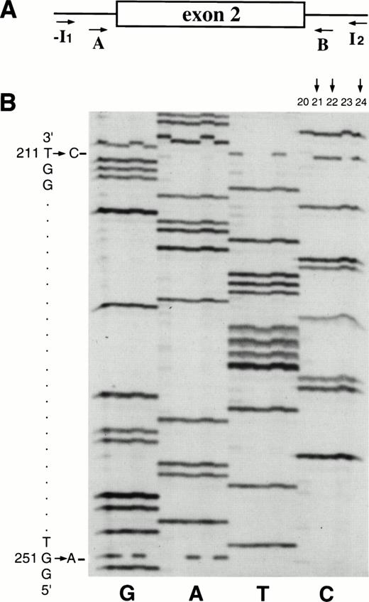 Fig. 6. Point mutations in exon 2 of the PIG-A gene in patient MSK13 before BMT. (A) Exon 2 of the PIG-A gene was first amplified by external primers -I1 and I2, and then reamplified with the internal primers (see Table 1). (B) Nt sequence of M13 clones containing exon 2 fragment of patient MSK13. All (G) reactions were loaded adjacent to each other, followed by the (A, T, and C) reactions. Two of the 3 M13 clones with substitution 211 T → C (clones 21, 22, 24) also have the 251 G → A substitution (clones 22 and 24).