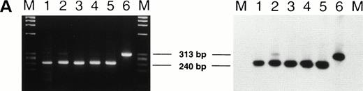 Fig. 2. (A) RT-PCR products of proband LI-1 and controls using primers AP1 and AP2 (see Fig 1). Ethidium bromide-stained 2% agarose gel is on the left and autoradiograph of Southern blot of the gel, hybridized with oligoprobe OP, is shown on the right. The lanes are represented by M: ◊X174 RF DNA-HaeIII; 1 and 3: normal controls; 2: LI-1 (proband); 4 and 5: CI-1 and CI-2 (asymptomatic heterozygotes); and 6: CII-1 (homozygote for the IVS 2-654 mutation). (B) Radioactive RT-PCR of β mRNA of probands and controls using primers AP3 and radiolabelled AP2 after 20 cycles of amplification. The mutant (β654) and normal (βN) cDNAs are 503 and 430 bp, respectively. The lanes are represented by M: pBR322 DNA-Msp I marker; 1: Proband LI-1; 2: Proband LII-3; 3: CII-1 (homozygote for β IVS 2-654); lanes 4 to 9: asymptomatic heterozygote controls; 10: AH (β IVS 2-654/(Aγδβ)0 thalassemia); 11: normal control.