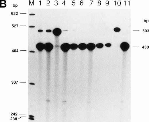 Fig. 2. (A) RT-PCR products of proband LI-1 and controls using primers AP1 and AP2 (see Fig 1). Ethidium bromide-stained 2% agarose gel is on the left and autoradiograph of Southern blot of the gel, hybridized with oligoprobe OP, is shown on the right. The lanes are represented by M: ◊X174 RF DNA-HaeIII; 1 and 3: normal controls; 2: LI-1 (proband); 4 and 5: CI-1 and CI-2 (asymptomatic heterozygotes); and 6: CII-1 (homozygote for the IVS 2-654 mutation). (B) Radioactive RT-PCR of β mRNA of probands and controls using primers AP3 and radiolabelled AP2 after 20 cycles of amplification. The mutant (β654) and normal (βN) cDNAs are 503 and 430 bp, respectively. The lanes are represented by M: pBR322 DNA-Msp I marker; 1: Proband LI-1; 2: Proband LII-3; 3: CII-1 (homozygote for β IVS 2-654); lanes 4 to 9: asymptomatic heterozygote controls; 10: AH (β IVS 2-654/(Aγδβ)0 thalassemia); 11: normal control.