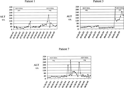 Fig. 1. Three patients who developed moderate ALT increase followed by chronic liver dysfunction. Levels of ALT (U/L, dotted line) are plotted against the date of determination. The upper reference limit for ALT was 40 U/L. The results of HGV RNA determination, performed at the beginning and at the end of follow-up, are also reported. These patients had a higher increase of serum ferritin levels than those who maintained normal aminotransferase values (difference of ferritin concentration between follow-up and baseline sample, 1,850 ± 368 ng/mL v 111 ± 814 ng /mL).