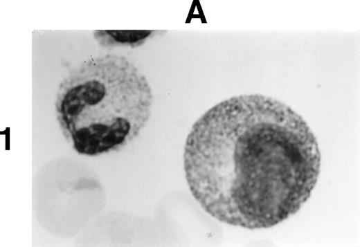 Fig. 1. (A1) Two neutrophils from a case of APL with CH-like granules. The promyelocytes looks normal in all parameters except in the primary granules. They are more abundant than normally seen; they are immature, different sized, and there is no dark purple of blue mature azure granules. The PMN looks normal except for increased number of primary (azure) immature granules. (B1) A promyelocyte from the same case of APL. Abundance of immature azure granules of different sizes. None of them mature and none are of abnormal sizes. There is one vacuole and the Golgi apparatus is clearly visible. (C1) Two promyelocytes similar to B1. Some azure granules undergo aggregation. (A2) Two promyelocytes in the same bone marrow smear. Split of maturational direction. One cell shows numerous Auer body–like inclusions and clear cytoplasm. The other shows numerous aggregates of azure granules. Some of them suggest fusion of smaller granules. (B2) Typical appearance of a bone marrow high-power field. Several leukemic promyelocytes. One shows Auer body–like inclusions. Others show immature azure granules at different levels of aggregation. The typical CH-like granules are not present. (C2) One large leukemic promyelocyte. A gigantic, pink, polygonal granule if formed. Many polygonal aggregates of small azure granules. Some clearing of cytoplasm (reduced total number of granules) can be seen. (A3) Fully developed CH-like granule in a leukemic promyelocyte. Other azure granules and, particularly, aggregates are not part of this granule. They follow their own development. Clearing of cytoplasm is also present. (B3) Several large and one gigantic, fully developed, pink-color and polygonal-shaped azure granules. Clear cytoplasm. This is a picture of a typical cell. (C3) A promyelocyte with three gigantic CH-like granules. All three are round, and all show structural changes. Onion- or myelin-like figures appear inside granules. They are apparently composed of the same material as other CH-like granules. Changes indicate hyalinization and autolysis. (A4) Two promyelocytes: one with Auer body–like inclusions, and the other with two small CH-like granules undergoing autolysis and one huge vacuole containing residual hyaline material of a CH-like granule, and a transparent, watery content. (B4) Two promyelocytes with gigantic, autolytic granules-vacuoles. Both resemble macrophages and phagocytosis. Only the presence of other azure granules in one of them suggest neutrophilic origin of this cell. (C4) A leukemic promyelocyte with many vacuoles. Few show some content. One (at 2 o’clock) is opened toward the cell exterior and some cytoplasmic ridges can be seen around the “rupture.” Two nucleoli identify the immaturity of the cell.