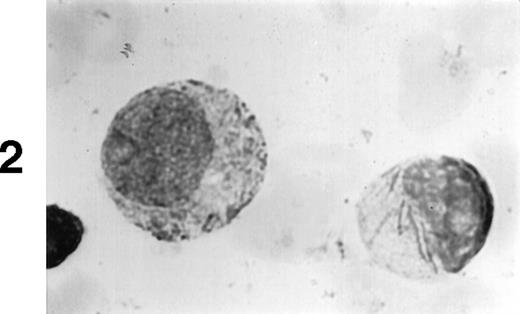 Fig. 1. (A1) Two neutrophils from a case of APL with CH-like granules. The promyelocytes looks normal in all parameters except in the primary granules. They are more abundant than normally seen; they are immature, different sized, and there is no dark purple of blue mature azure granules. The PMN looks normal except for increased number of primary (azure) immature granules. (B1) A promyelocyte from the same case of APL. Abundance of immature azure granules of different sizes. None of them mature and none are of abnormal sizes. There is one vacuole and the Golgi apparatus is clearly visible. (C1) Two promyelocytes similar to B1. Some azure granules undergo aggregation. (A2) Two promyelocytes in the same bone marrow smear. Split of maturational direction. One cell shows numerous Auer body–like inclusions and clear cytoplasm. The other shows numerous aggregates of azure granules. Some of them suggest fusion of smaller granules. (B2) Typical appearance of a bone marrow high-power field. Several leukemic promyelocytes. One shows Auer body–like inclusions. Others show immature azure granules at different levels of aggregation. The typical CH-like granules are not present. (C2) One large leukemic promyelocyte. A gigantic, pink, polygonal granule if formed. Many polygonal aggregates of small azure granules. Some clearing of cytoplasm (reduced total number of granules) can be seen. (A3) Fully developed CH-like granule in a leukemic promyelocyte. Other azure granules and, particularly, aggregates are not part of this granule. They follow their own development. Clearing of cytoplasm is also present. (B3) Several large and one gigantic, fully developed, pink-color and polygonal-shaped azure granules. Clear cytoplasm. This is a picture of a typical cell. (C3) A promyelocyte with three gigantic CH-like granules. All three are round, and all show structural changes. Onion- or myelin-like figures appear inside granules. They are apparently composed of the same material as other CH-like granules. Changes indicate hyalinization and autolysis. (A4) Two promyelocytes: one with Auer body–like inclusions, and the other with two small CH-like granules undergoing autolysis and one huge vacuole containing residual hyaline material of a CH-like granule, and a transparent, watery content. (B4) Two promyelocytes with gigantic, autolytic granules-vacuoles. Both resemble macrophages and phagocytosis. Only the presence of other azure granules in one of them suggest neutrophilic origin of this cell. (C4) A leukemic promyelocyte with many vacuoles. Few show some content. One (at 2 o’clock) is opened toward the cell exterior and some cytoplasmic ridges can be seen around the “rupture.” Two nucleoli identify the immaturity of the cell.