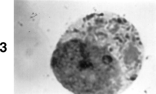 Fig. 1. (A1) Two neutrophils from a case of APL with CH-like granules. The promyelocytes looks normal in all parameters except in the primary granules. They are more abundant than normally seen; they are immature, different sized, and there is no dark purple of blue mature azure granules. The PMN looks normal except for increased number of primary (azure) immature granules. (B1) A promyelocyte from the same case of APL. Abundance of immature azure granules of different sizes. None of them mature and none are of abnormal sizes. There is one vacuole and the Golgi apparatus is clearly visible. (C1) Two promyelocytes similar to B1. Some azure granules undergo aggregation. (A2) Two promyelocytes in the same bone marrow smear. Split of maturational direction. One cell shows numerous Auer body–like inclusions and clear cytoplasm. The other shows numerous aggregates of azure granules. Some of them suggest fusion of smaller granules. (B2) Typical appearance of a bone marrow high-power field. Several leukemic promyelocytes. One shows Auer body–like inclusions. Others show immature azure granules at different levels of aggregation. The typical CH-like granules are not present. (C2) One large leukemic promyelocyte. A gigantic, pink, polygonal granule if formed. Many polygonal aggregates of small azure granules. Some clearing of cytoplasm (reduced total number of granules) can be seen. (A3) Fully developed CH-like granule in a leukemic promyelocyte. Other azure granules and, particularly, aggregates are not part of this granule. They follow their own development. Clearing of cytoplasm is also present. (B3) Several large and one gigantic, fully developed, pink-color and polygonal-shaped azure granules. Clear cytoplasm. This is a picture of a typical cell. (C3) A promyelocyte with three gigantic CH-like granules. All three are round, and all show structural changes. Onion- or myelin-like figures appear inside granules. They are apparently composed of the same material as other CH-like granules. Changes indicate hyalinization and autolysis. (A4) Two promyelocytes: one with Auer body–like inclusions, and the other with two small CH-like granules undergoing autolysis and one huge vacuole containing residual hyaline material of a CH-like granule, and a transparent, watery content. (B4) Two promyelocytes with gigantic, autolytic granules-vacuoles. Both resemble macrophages and phagocytosis. Only the presence of other azure granules in one of them suggest neutrophilic origin of this cell. (C4) A leukemic promyelocyte with many vacuoles. Few show some content. One (at 2 o’clock) is opened toward the cell exterior and some cytoplasmic ridges can be seen around the “rupture.” Two nucleoli identify the immaturity of the cell.