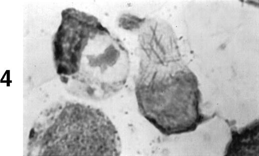 Fig. 1. (A1) Two neutrophils from a case of APL with CH-like granules. The promyelocytes looks normal in all parameters except in the primary granules. They are more abundant than normally seen; they are immature, different sized, and there is no dark purple of blue mature azure granules. The PMN looks normal except for increased number of primary (azure) immature granules. (B1) A promyelocyte from the same case of APL. Abundance of immature azure granules of different sizes. None of them mature and none are of abnormal sizes. There is one vacuole and the Golgi apparatus is clearly visible. (C1) Two promyelocytes similar to B1. Some azure granules undergo aggregation. (A2) Two promyelocytes in the same bone marrow smear. Split of maturational direction. One cell shows numerous Auer body–like inclusions and clear cytoplasm. The other shows numerous aggregates of azure granules. Some of them suggest fusion of smaller granules. (B2) Typical appearance of a bone marrow high-power field. Several leukemic promyelocytes. One shows Auer body–like inclusions. Others show immature azure granules at different levels of aggregation. The typical CH-like granules are not present. (C2) One large leukemic promyelocyte. A gigantic, pink, polygonal granule if formed. Many polygonal aggregates of small azure granules. Some clearing of cytoplasm (reduced total number of granules) can be seen. (A3) Fully developed CH-like granule in a leukemic promyelocyte. Other azure granules and, particularly, aggregates are not part of this granule. They follow their own development. Clearing of cytoplasm is also present. (B3) Several large and one gigantic, fully developed, pink-color and polygonal-shaped azure granules. Clear cytoplasm. This is a picture of a typical cell. (C3) A promyelocyte with three gigantic CH-like granules. All three are round, and all show structural changes. Onion- or myelin-like figures appear inside granules. They are apparently composed of the same material as other CH-like granules. Changes indicate hyalinization and autolysis. (A4) Two promyelocytes: one with Auer body–like inclusions, and the other with two small CH-like granules undergoing autolysis and one huge vacuole containing residual hyaline material of a CH-like granule, and a transparent, watery content. (B4) Two promyelocytes with gigantic, autolytic granules-vacuoles. Both resemble macrophages and phagocytosis. Only the presence of other azure granules in one of them suggest neutrophilic origin of this cell. (C4) A leukemic promyelocyte with many vacuoles. Few show some content. One (at 2 o’clock) is opened toward the cell exterior and some cytoplasmic ridges can be seen around the “rupture.” Two nucleoli identify the immaturity of the cell.