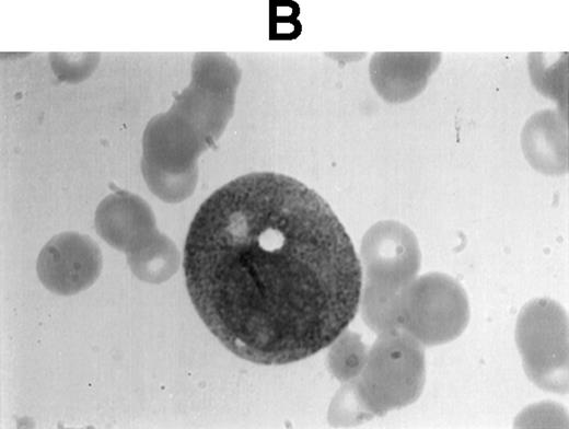 Fig. 1. (A1) Two neutrophils from a case of APL with CH-like granules. The promyelocytes looks normal in all parameters except in the primary granules. They are more abundant than normally seen; they are immature, different sized, and there is no dark purple of blue mature azure granules. The PMN looks normal except for increased number of primary (azure) immature granules. (B1) A promyelocyte from the same case of APL. Abundance of immature azure granules of different sizes. None of them mature and none are of abnormal sizes. There is one vacuole and the Golgi apparatus is clearly visible. (C1) Two promyelocytes similar to B1. Some azure granules undergo aggregation. (A2) Two promyelocytes in the same bone marrow smear. Split of maturational direction. One cell shows numerous Auer body–like inclusions and clear cytoplasm. The other shows numerous aggregates of azure granules. Some of them suggest fusion of smaller granules. (B2) Typical appearance of a bone marrow high-power field. Several leukemic promyelocytes. One shows Auer body–like inclusions. Others show immature azure granules at different levels of aggregation. The typical CH-like granules are not present. (C2) One large leukemic promyelocyte. A gigantic, pink, polygonal granule if formed. Many polygonal aggregates of small azure granules. Some clearing of cytoplasm (reduced total number of granules) can be seen. (A3) Fully developed CH-like granule in a leukemic promyelocyte. Other azure granules and, particularly, aggregates are not part of this granule. They follow their own development. Clearing of cytoplasm is also present. (B3) Several large and one gigantic, fully developed, pink-color and polygonal-shaped azure granules. Clear cytoplasm. This is a picture of a typical cell. (C3) A promyelocyte with three gigantic CH-like granules. All three are round, and all show structural changes. Onion- or myelin-like figures appear inside granules. They are apparently composed of the same material as other CH-like granules. Changes indicate hyalinization and autolysis. (A4) Two promyelocytes: one with Auer body–like inclusions, and the other with two small CH-like granules undergoing autolysis and one huge vacuole containing residual hyaline material of a CH-like granule, and a transparent, watery content. (B4) Two promyelocytes with gigantic, autolytic granules-vacuoles. Both resemble macrophages and phagocytosis. Only the presence of other azure granules in one of them suggest neutrophilic origin of this cell. (C4) A leukemic promyelocyte with many vacuoles. Few show some content. One (at 2 o’clock) is opened toward the cell exterior and some cytoplasmic ridges can be seen around the “rupture.” Two nucleoli identify the immaturity of the cell.