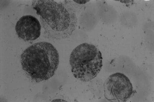 Fig. 1. (A1) Two neutrophils from a case of APL with CH-like granules. The promyelocytes looks normal in all parameters except in the primary granules. They are more abundant than normally seen; they are immature, different sized, and there is no dark purple of blue mature azure granules. The PMN looks normal except for increased number of primary (azure) immature granules. (B1) A promyelocyte from the same case of APL. Abundance of immature azure granules of different sizes. None of them mature and none are of abnormal sizes. There is one vacuole and the Golgi apparatus is clearly visible. (C1) Two promyelocytes similar to B1. Some azure granules undergo aggregation. (A2) Two promyelocytes in the same bone marrow smear. Split of maturational direction. One cell shows numerous Auer body–like inclusions and clear cytoplasm. The other shows numerous aggregates of azure granules. Some of them suggest fusion of smaller granules. (B2) Typical appearance of a bone marrow high-power field. Several leukemic promyelocytes. One shows Auer body–like inclusions. Others show immature azure granules at different levels of aggregation. The typical CH-like granules are not present. (C2) One large leukemic promyelocyte. A gigantic, pink, polygonal granule if formed. Many polygonal aggregates of small azure granules. Some clearing of cytoplasm (reduced total number of granules) can be seen. (A3) Fully developed CH-like granule in a leukemic promyelocyte. Other azure granules and, particularly, aggregates are not part of this granule. They follow their own development. Clearing of cytoplasm is also present. (B3) Several large and one gigantic, fully developed, pink-color and polygonal-shaped azure granules. Clear cytoplasm. This is a picture of a typical cell. (C3) A promyelocyte with three gigantic CH-like granules. All three are round, and all show structural changes. Onion- or myelin-like figures appear inside granules. They are apparently composed of the same material as other CH-like granules. Changes indicate hyalinization and autolysis. (A4) Two promyelocytes: one with Auer body–like inclusions, and the other with two small CH-like granules undergoing autolysis and one huge vacuole containing residual hyaline material of a CH-like granule, and a transparent, watery content. (B4) Two promyelocytes with gigantic, autolytic granules-vacuoles. Both resemble macrophages and phagocytosis. Only the presence of other azure granules in one of them suggest neutrophilic origin of this cell. (C4) A leukemic promyelocyte with many vacuoles. Few show some content. One (at 2 o’clock) is opened toward the cell exterior and some cytoplasmic ridges can be seen around the “rupture.” Two nucleoli identify the immaturity of the cell.