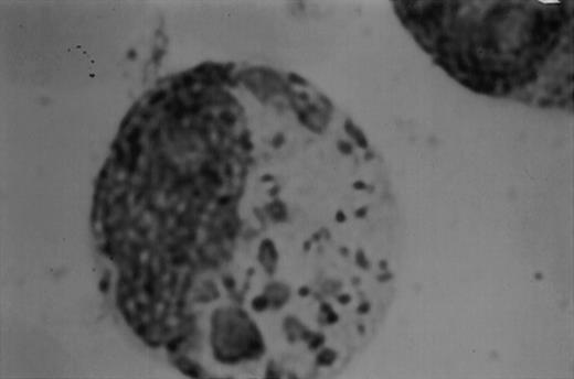 Fig. 1. (A1) Two neutrophils from a case of APL with CH-like granules. The promyelocytes looks normal in all parameters except in the primary granules. They are more abundant than normally seen; they are immature, different sized, and there is no dark purple of blue mature azure granules. The PMN looks normal except for increased number of primary (azure) immature granules. (B1) A promyelocyte from the same case of APL. Abundance of immature azure granules of different sizes. None of them mature and none are of abnormal sizes. There is one vacuole and the Golgi apparatus is clearly visible. (C1) Two promyelocytes similar to B1. Some azure granules undergo aggregation. (A2) Two promyelocytes in the same bone marrow smear. Split of maturational direction. One cell shows numerous Auer body–like inclusions and clear cytoplasm. The other shows numerous aggregates of azure granules. Some of them suggest fusion of smaller granules. (B2) Typical appearance of a bone marrow high-power field. Several leukemic promyelocytes. One shows Auer body–like inclusions. Others show immature azure granules at different levels of aggregation. The typical CH-like granules are not present. (C2) One large leukemic promyelocyte. A gigantic, pink, polygonal granule if formed. Many polygonal aggregates of small azure granules. Some clearing of cytoplasm (reduced total number of granules) can be seen. (A3) Fully developed CH-like granule in a leukemic promyelocyte. Other azure granules and, particularly, aggregates are not part of this granule. They follow their own development. Clearing of cytoplasm is also present. (B3) Several large and one gigantic, fully developed, pink-color and polygonal-shaped azure granules. Clear cytoplasm. This is a picture of a typical cell. (C3) A promyelocyte with three gigantic CH-like granules. All three are round, and all show structural changes. Onion- or myelin-like figures appear inside granules. They are apparently composed of the same material as other CH-like granules. Changes indicate hyalinization and autolysis. (A4) Two promyelocytes: one with Auer body–like inclusions, and the other with two small CH-like granules undergoing autolysis and one huge vacuole containing residual hyaline material of a CH-like granule, and a transparent, watery content. (B4) Two promyelocytes with gigantic, autolytic granules-vacuoles. Both resemble macrophages and phagocytosis. Only the presence of other azure granules in one of them suggest neutrophilic origin of this cell. (C4) A leukemic promyelocyte with many vacuoles. Few show some content. One (at 2 o’clock) is opened toward the cell exterior and some cytoplasmic ridges can be seen around the “rupture.” Two nucleoli identify the immaturity of the cell.