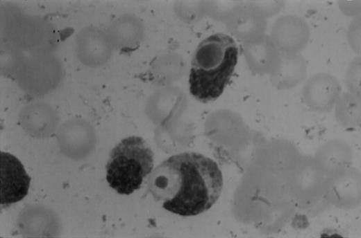 Fig. 1. (A1) Two neutrophils from a case of APL with CH-like granules. The promyelocytes looks normal in all parameters except in the primary granules. They are more abundant than normally seen; they are immature, different sized, and there is no dark purple of blue mature azure granules. The PMN looks normal except for increased number of primary (azure) immature granules. (B1) A promyelocyte from the same case of APL. Abundance of immature azure granules of different sizes. None of them mature and none are of abnormal sizes. There is one vacuole and the Golgi apparatus is clearly visible. (C1) Two promyelocytes similar to B1. Some azure granules undergo aggregation. (A2) Two promyelocytes in the same bone marrow smear. Split of maturational direction. One cell shows numerous Auer body–like inclusions and clear cytoplasm. The other shows numerous aggregates of azure granules. Some of them suggest fusion of smaller granules. (B2) Typical appearance of a bone marrow high-power field. Several leukemic promyelocytes. One shows Auer body–like inclusions. Others show immature azure granules at different levels of aggregation. The typical CH-like granules are not present. (C2) One large leukemic promyelocyte. A gigantic, pink, polygonal granule if formed. Many polygonal aggregates of small azure granules. Some clearing of cytoplasm (reduced total number of granules) can be seen. (A3) Fully developed CH-like granule in a leukemic promyelocyte. Other azure granules and, particularly, aggregates are not part of this granule. They follow their own development. Clearing of cytoplasm is also present. (B3) Several large and one gigantic, fully developed, pink-color and polygonal-shaped azure granules. Clear cytoplasm. This is a picture of a typical cell. (C3) A promyelocyte with three gigantic CH-like granules. All three are round, and all show structural changes. Onion- or myelin-like figures appear inside granules. They are apparently composed of the same material as other CH-like granules. Changes indicate hyalinization and autolysis. (A4) Two promyelocytes: one with Auer body–like inclusions, and the other with two small CH-like granules undergoing autolysis and one huge vacuole containing residual hyaline material of a CH-like granule, and a transparent, watery content. (B4) Two promyelocytes with gigantic, autolytic granules-vacuoles. Both resemble macrophages and phagocytosis. Only the presence of other azure granules in one of them suggest neutrophilic origin of this cell. (C4) A leukemic promyelocyte with many vacuoles. Few show some content. One (at 2 o’clock) is opened toward the cell exterior and some cytoplasmic ridges can be seen around the “rupture.” Two nucleoli identify the immaturity of the cell.