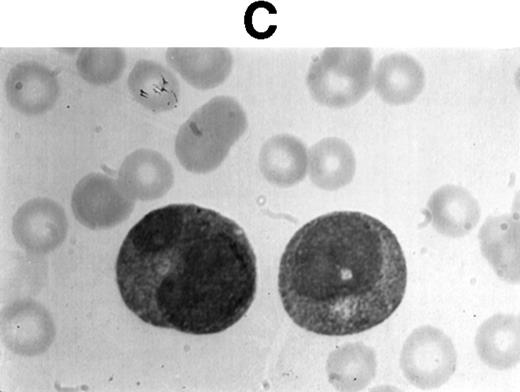 Fig. 1. (A1) Two neutrophils from a case of APL with CH-like granules. The promyelocytes looks normal in all parameters except in the primary granules. They are more abundant than normally seen; they are immature, different sized, and there is no dark purple of blue mature azure granules. The PMN looks normal except for increased number of primary (azure) immature granules. (B1) A promyelocyte from the same case of APL. Abundance of immature azure granules of different sizes. None of them mature and none are of abnormal sizes. There is one vacuole and the Golgi apparatus is clearly visible. (C1) Two promyelocytes similar to B1. Some azure granules undergo aggregation. (A2) Two promyelocytes in the same bone marrow smear. Split of maturational direction. One cell shows numerous Auer body–like inclusions and clear cytoplasm. The other shows numerous aggregates of azure granules. Some of them suggest fusion of smaller granules. (B2) Typical appearance of a bone marrow high-power field. Several leukemic promyelocytes. One shows Auer body–like inclusions. Others show immature azure granules at different levels of aggregation. The typical CH-like granules are not present. (C2) One large leukemic promyelocyte. A gigantic, pink, polygonal granule if formed. Many polygonal aggregates of small azure granules. Some clearing of cytoplasm (reduced total number of granules) can be seen. (A3) Fully developed CH-like granule in a leukemic promyelocyte. Other azure granules and, particularly, aggregates are not part of this granule. They follow their own development. Clearing of cytoplasm is also present. (B3) Several large and one gigantic, fully developed, pink-color and polygonal-shaped azure granules. Clear cytoplasm. This is a picture of a typical cell. (C3) A promyelocyte with three gigantic CH-like granules. All three are round, and all show structural changes. Onion- or myelin-like figures appear inside granules. They are apparently composed of the same material as other CH-like granules. Changes indicate hyalinization and autolysis. (A4) Two promyelocytes: one with Auer body–like inclusions, and the other with two small CH-like granules undergoing autolysis and one huge vacuole containing residual hyaline material of a CH-like granule, and a transparent, watery content. (B4) Two promyelocytes with gigantic, autolytic granules-vacuoles. Both resemble macrophages and phagocytosis. Only the presence of other azure granules in one of them suggest neutrophilic origin of this cell. (C4) A leukemic promyelocyte with many vacuoles. Few show some content. One (at 2 o’clock) is opened toward the cell exterior and some cytoplasmic ridges can be seen around the “rupture.” Two nucleoli identify the immaturity of the cell.