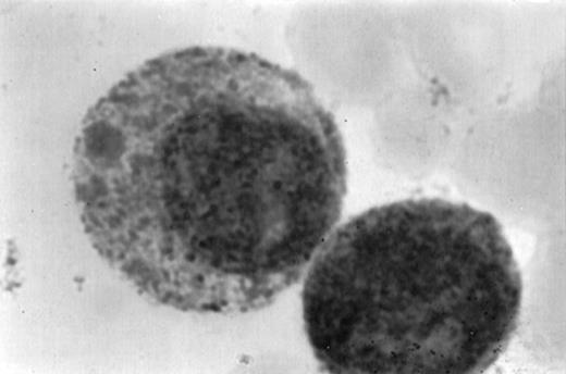 Fig. 1. (A1) Two neutrophils from a case of APL with CH-like granules. The promyelocytes looks normal in all parameters except in the primary granules. They are more abundant than normally seen; they are immature, different sized, and there is no dark purple of blue mature azure granules. The PMN looks normal except for increased number of primary (azure) immature granules. (B1) A promyelocyte from the same case of APL. Abundance of immature azure granules of different sizes. None of them mature and none are of abnormal sizes. There is one vacuole and the Golgi apparatus is clearly visible. (C1) Two promyelocytes similar to B1. Some azure granules undergo aggregation. (A2) Two promyelocytes in the same bone marrow smear. Split of maturational direction. One cell shows numerous Auer body–like inclusions and clear cytoplasm. The other shows numerous aggregates of azure granules. Some of them suggest fusion of smaller granules. (B2) Typical appearance of a bone marrow high-power field. Several leukemic promyelocytes. One shows Auer body–like inclusions. Others show immature azure granules at different levels of aggregation. The typical CH-like granules are not present. (C2) One large leukemic promyelocyte. A gigantic, pink, polygonal granule if formed. Many polygonal aggregates of small azure granules. Some clearing of cytoplasm (reduced total number of granules) can be seen. (A3) Fully developed CH-like granule in a leukemic promyelocyte. Other azure granules and, particularly, aggregates are not part of this granule. They follow their own development. Clearing of cytoplasm is also present. (B3) Several large and one gigantic, fully developed, pink-color and polygonal-shaped azure granules. Clear cytoplasm. This is a picture of a typical cell. (C3) A promyelocyte with three gigantic CH-like granules. All three are round, and all show structural changes. Onion- or myelin-like figures appear inside granules. They are apparently composed of the same material as other CH-like granules. Changes indicate hyalinization and autolysis. (A4) Two promyelocytes: one with Auer body–like inclusions, and the other with two small CH-like granules undergoing autolysis and one huge vacuole containing residual hyaline material of a CH-like granule, and a transparent, watery content. (B4) Two promyelocytes with gigantic, autolytic granules-vacuoles. Both resemble macrophages and phagocytosis. Only the presence of other azure granules in one of them suggest neutrophilic origin of this cell. (C4) A leukemic promyelocyte with many vacuoles. Few show some content. One (at 2 o’clock) is opened toward the cell exterior and some cytoplasmic ridges can be seen around the “rupture.” Two nucleoli identify the immaturity of the cell.