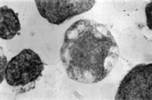 Fig. 1. (A1) Two neutrophils from a case of APL with CH-like granules. The promyelocytes looks normal in all parameters except in the primary granules. They are more abundant than normally seen; they are immature, different sized, and there is no dark purple of blue mature azure granules. The PMN looks normal except for increased number of primary (azure) immature granules. (B1) A promyelocyte from the same case of APL. Abundance of immature azure granules of different sizes. None of them mature and none are of abnormal sizes. There is one vacuole and the Golgi apparatus is clearly visible. (C1) Two promyelocytes similar to B1. Some azure granules undergo aggregation. (A2) Two promyelocytes in the same bone marrow smear. Split of maturational direction. One cell shows numerous Auer body–like inclusions and clear cytoplasm. The other shows numerous aggregates of azure granules. Some of them suggest fusion of smaller granules. (B2) Typical appearance of a bone marrow high-power field. Several leukemic promyelocytes. One shows Auer body–like inclusions. Others show immature azure granules at different levels of aggregation. The typical CH-like granules are not present. (C2) One large leukemic promyelocyte. A gigantic, pink, polygonal granule if formed. Many polygonal aggregates of small azure granules. Some clearing of cytoplasm (reduced total number of granules) can be seen. (A3) Fully developed CH-like granule in a leukemic promyelocyte. Other azure granules and, particularly, aggregates are not part of this granule. They follow their own development. Clearing of cytoplasm is also present. (B3) Several large and one gigantic, fully developed, pink-color and polygonal-shaped azure granules. Clear cytoplasm. This is a picture of a typical cell. (C3) A promyelocyte with three gigantic CH-like granules. All three are round, and all show structural changes. Onion- or myelin-like figures appear inside granules. They are apparently composed of the same material as other CH-like granules. Changes indicate hyalinization and autolysis. (A4) Two promyelocytes: one with Auer body–like inclusions, and the other with two small CH-like granules undergoing autolysis and one huge vacuole containing residual hyaline material of a CH-like granule, and a transparent, watery content. (B4) Two promyelocytes with gigantic, autolytic granules-vacuoles. Both resemble macrophages and phagocytosis. Only the presence of other azure granules in one of them suggest neutrophilic origin of this cell. (C4) A leukemic promyelocyte with many vacuoles. Few show some content. One (at 2 o’clock) is opened toward the cell exterior and some cytoplasmic ridges can be seen around the “rupture.” Two nucleoli identify the immaturity of the cell.