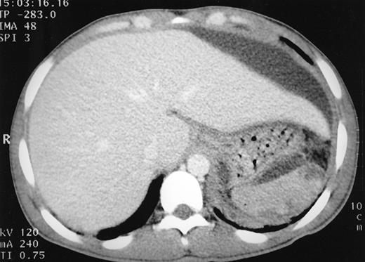 Fig. 1. CT scan of abdomen showing a large subcapsular collection of fluid compressing the left lobe of the liver. Liver and spleen appear normal.