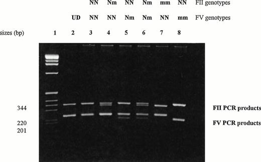 Fig. 1. Electrophoretic patterns for multiplex FV and FII PCR. The PCR mixture in a final volume of 50 μL consisted of 1 μg genomic DNA, PCR buffer (16.6 mmol/L amonium sulphate, 67 mmol/L Tris-HCl, pH 8.8, 6.7 mmol/L magnesium chloride, 67 μmol/L Na2EDTA, 170 μg bovine serum albumin per mL, 10 mmol/L β-mercaptoethanol), 400 μmol/L of each desoxynucleotide triphosphate, 30 pmol of each FV primer, 10 pmol of each FII primer, and 2 U Taq polymerase. Thermocycling conditions are 94°C (1 minute), 58°C (1 minute), 72°C (2 minutes) for 40 cycles. Fifteen microliters of PCR product is digested with 15 U HindIII restriction enzyme. The restricted products are separated by electrophresis through a 2% agarose gel stained with ethidium bromide and directly visualized under UV light. The smallest restricted fragments (32 and 23 bp) are not visible on the gel. Lane 1, size marker (1-kb ladder); lane 2, undigested PCR products; lanes 3 through 8, digested PCR products. UD, undigested PCR products; N, normal allele; m, mutated allele.