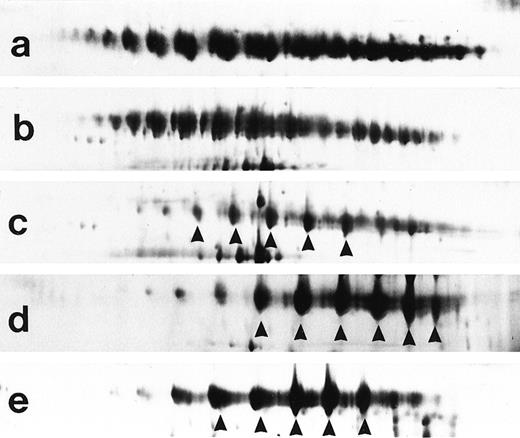Fig. 1. Representative examples of type III (a and b), type II-III (c), and type II cryoglobulins (d and e). Type II and II-III cryoglobulins are characterized by a dominant clonal IgM component (arrows).