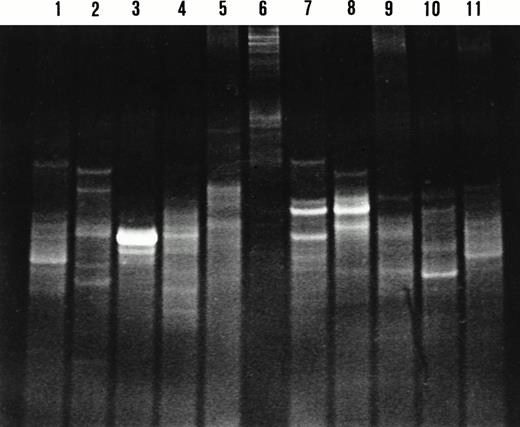 Fig. 4. DGGE analysis of IgH CDR3 PCR products from microdissected nodal and splenic marginal zones. Lane 1, lanes 2 and 3, lanes 4 to 6, lanes 7 to 8, lanes 9 to 10, and lane 11 represent cases 5, 6, 2, 4, 7, and 1, respectively. Two patterns are observed on the denaturing gradient gel: a smear indicating polyclonal IgH gene rearrangements in lanes 1, 5, 6, and 9; and one or multiple bands indicating clonal IgH gene rearrangements in lanes 2 to 4, 7, 8, 10, and 11. Lanes 7 and 8 display comigrating bands indicating the presence of the same B-cell clone in the respective marginal zones. Sequence analysis of these IgH CDR3 products confirmed the presence of the same clone.