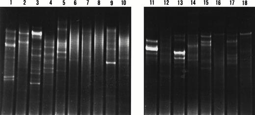 Fig. 5. DGGE analysis of IgH CDR3 PCR products from microdissected marginal zones and adjacent germinal centers. Lanes 1 to 4, lanes 5 to 10, lanes 11 to 14, and lanes 15 to 18 represent cases 4, 1, 5, and 7, respectively. The even and odd numbers represent the analysis of the marginal zones and adjacent germinal centers, respectively. Two patterns are observed: a smear indicating polyclonal IgH rearrangements in lanes 6, 7, 8, 10, and 12; and a pattern with one or multiple bands indicating clonal IgH rearrangements in lanes 1 to 5, 9, 11, and 13 to 18. The analysis of the IgH CDR3 PCR products from Ki67-expressing marginal zones are observed in lanes 2, 4, 6, and 10.