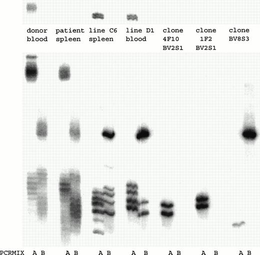 Fig. 3. PCR analysis of the TCRBV expression using BV-specific primers showed that in both T-cell lines BV2+ and BV8S3+ T-cell clones were present. By limiting dilution, two different types of BV2+ T-cell clones 4F10 and 1F2, and one type of BV8S3+ T-cell clone were obtained. PCR mix A contained primers for TCR BV2, BV6, BV17, BV18, and BV21; mix B contained primers for TCR BV5S1, BV7, BV8, BV9, BV14, and BV23. Both BV2+ T-cell clones 4F10 and 1F2 show two bands because of the difference in running pattern of the single-stranded cDNA fragments after denaturation.