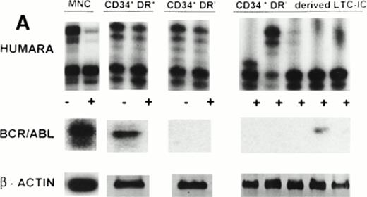 Fig. 1. (A) X-inactivation patterns with the HUMARA assay and BCR/ABL mRNA expression in MNC, CD34+HLA-DR+, CD34+HLA-DR−, and DR− derived LTC-IC in steady-state marrow in ECP CML. HUMARA PCR and BCR/ABL and β-actin RT-PCR reactions were performed as described in Materials and Methods. Results are shown for one experiment in marrow from UPN 1. HUMARA PCRs are shown without (−) and with (+) prior exposure toHpaII and Cfo I restriction endonucleases. Shadow bands are due to slippage of Taq polymerase. BCR/ABL yielded positive signals in the MNC and DR+ fraction and in one LTC-IC–derived colony, after hybridization with a B3A2 probe. No positive signal was detected in the other samples. The housekeeping gene β-actin was used as an internal control for the presence of mRNA. (B) HUMARA analysis and BCR/ABL mRNA expression in mobilized PB in ECP CML. Results are shown for day 3 harvest from UPN 1. HUMARA PCR and BCR/ABL and β-actin RT-PCR reactions were performed as described in Materials and Methods. HUMARA was performed without (−) and with (+) predigestion with the methylation-sensitive endonucleases HpaII andCfo I. MNC displayed monoclonal patterns and BCR/ABL mRNA positivity, whereas CD34+HLA-DR+ and CD34+HLA-DR− progenitors were polyclonal and BCR/ABL mRNA−. The erythroleukemic cell line K562 served as a positive control for BCR/ABL (B3A2) expression. The housekeeping gene β-actin was used as a control for the presence of mRNA.
