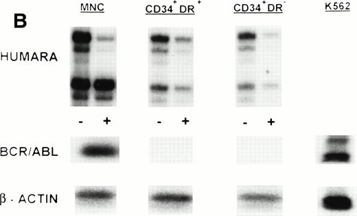 Fig. 1. (A) X-inactivation patterns with the HUMARA assay and BCR/ABL mRNA expression in MNC, CD34+HLA-DR+, CD34+HLA-DR−, and DR− derived LTC-IC in steady-state marrow in ECP CML. HUMARA PCR and BCR/ABL and β-actin RT-PCR reactions were performed as described in Materials and Methods. Results are shown for one experiment in marrow from UPN 1. HUMARA PCRs are shown without (−) and with (+) prior exposure toHpaII and Cfo I restriction endonucleases. Shadow bands are due to slippage of Taq polymerase. BCR/ABL yielded positive signals in the MNC and DR+ fraction and in one LTC-IC–derived colony, after hybridization with a B3A2 probe. No positive signal was detected in the other samples. The housekeeping gene β-actin was used as an internal control for the presence of mRNA. (B) HUMARA analysis and BCR/ABL mRNA expression in mobilized PB in ECP CML. Results are shown for day 3 harvest from UPN 1. HUMARA PCR and BCR/ABL and β-actin RT-PCR reactions were performed as described in Materials and Methods. HUMARA was performed without (−) and with (+) predigestion with the methylation-sensitive endonucleases HpaII andCfo I. MNC displayed monoclonal patterns and BCR/ABL mRNA positivity, whereas CD34+HLA-DR+ and CD34+HLA-DR− progenitors were polyclonal and BCR/ABL mRNA−. The erythroleukemic cell line K562 served as a positive control for BCR/ABL (B3A2) expression. The housekeeping gene β-actin was used as a control for the presence of mRNA.