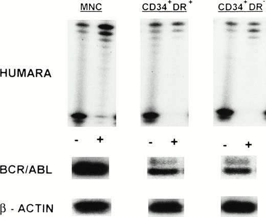 Fig. 2. X-inactivation patterns with the HUMARA assay and BCR/ABL mRNA expression in MNC, CD34+HLA-DR+, and CD34+HLA-DR− progenitors in steady-state marrow in AP CML. Results are shown for marrow from UPN 9. HUMARA PCR and BCR/ABL and β-actin RT-PCR reactions were performed as described in Materials and Methods. HUMARA was performed without (−) and with (+) predigestion with the methylation-sensitive endonucleasesHpaII and Cfo I. All samples show monoclonality. BCR/ABL results are shown after hybridization with the B3A2 probe. The housekeeping gene β-actin was used as a control for the presence of mRNA.