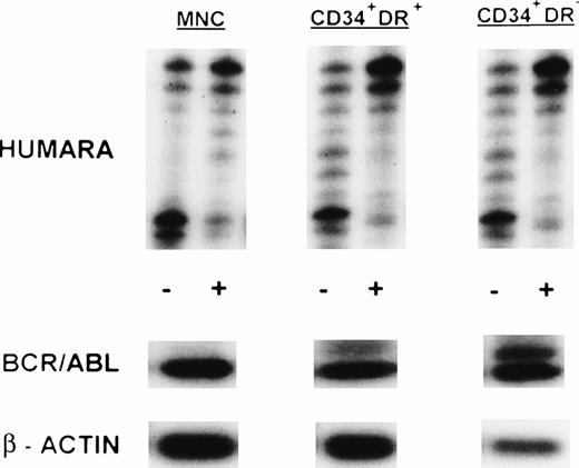 Fig. 4. HUMARA analysis and BCR/ABL mRNA expression in mobilized PB in LCP CML. Results are shown for day 1 harvest from UPN 5. HUMARA PCR and BCR/ABL and β-actin RT-PCR reactions were performed as described in Materials and Methods. MNC, CD34+HLA-DR+, and CD34+HLA-DR− progenitors were monoclonal and BCR/ABL mRNA+. Shadow bands in the HUMARA PCR are caused by slippage of Taq polymerase. (−), No prior digest withHpaII and Cfo I; (+), prior digest with HpaII and Cfo I.
