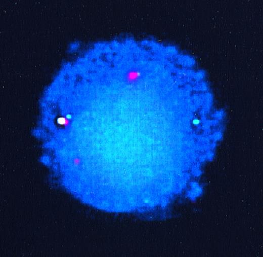 Fig. 2. FISH of interphase nuclei from lymphoblasts of patient 55. The germline ETV6 allele is seen as a green signal, germline AML1 as orange, derivative 21 (ETV6-AML1fusion) as yellow, and the derivative 12 (AML1-ETV6 fusion) also as orange.