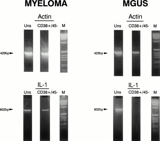 Fig. 4. Cytokine detection by flow cytometry/RT-PCR. Marrow aspirates were sorted by flow cytometry using anti-CD38 and anti-CD45 antibodies. Messenger RNA was isolated from 105 to 106 unsorted (U) and sorted CD38+/CD45− (S) cells. Subsequently, RT-PCR with specific cytokine primers was performed to detect the presence of message for IL-1β and actin. IL-1β mRNA was detectable in sorted CD38+/CD45−cells from the myeloma patient but not from the MGUS patient.