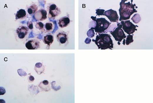 Fig. 1. ISH for IL-1β in a patient with MM. (A) IL-1β; (B) lambda; (C) kappa. Plasma cells from a patient with MM were negative for kappa expression but positive for IL-1β and lambda expression as shown by the strong brown-black cytoplasmic staining. All slides were counter-stained in hematoxylin.