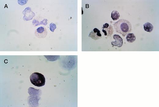 Fig. 2. ISH for IL-1β in a patient with MGUS. (A) IL-1β; (B) lambda; (C) kappa. Plasma cells from this MGUS patient were positive for kappa expression and negative for lambda and IL-1β.