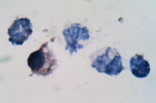 Fig. 3. ISH for IL-1β in a patient with MGUS. Plasma cells from this MGUS patient were positive for IL-1β.