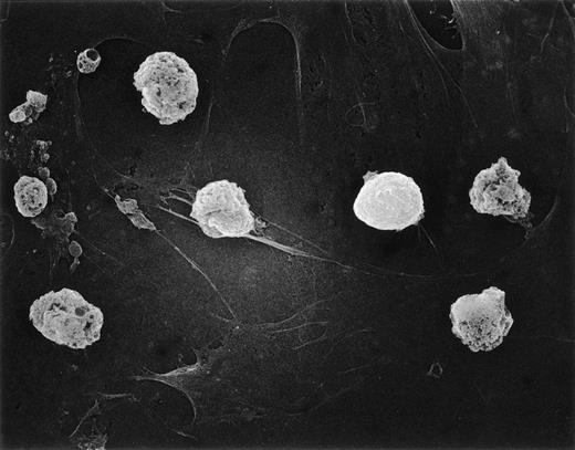 Fig. 5. Hyperdiploid lymphoblasts adhere to stroma. Scanning electron microscopy of hyperdiploid lymphoblasts after 3 days of culture on bone marrow–derived stroma. Most cells are dying despite tight adhesion to stromal elements.