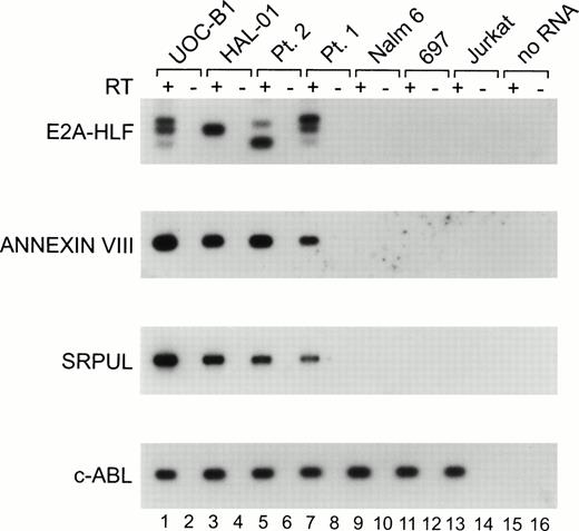 Fig. 4. RT-PCR analysis. Each RNA was transcribed with (+; odd lanes) or without (−; even lanes) RT. The PCR products were transferred to a nylon membrane and analyzed by hybridization with end-labeled internal oligonucleotide probes specific for each gene. RNAs were evaluated for the UOC-B1 (lanes 1 and 2) and HAL-01 (lanes 3 and 4) t(17;19)-positive human leukemic cell lines, patient samples with t(17;19)-positive ALL (lanes 5 through 8), the t(17;19)-negative Nalm6 early B-lineage leukemic cell line (lanes 9 and 10), 697 pre-B leukemic cell line (lanes 11 and 12), and Jurkat T-cell leukemic cell line (lanes 13 and 14), as well as a control PCR reaction lacking RNA template (lanes 15 and 16).